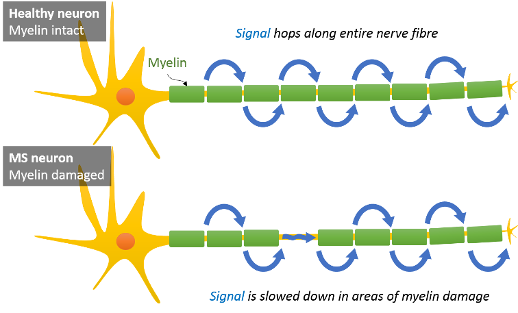 Daclizumab – Manipulating the immune system in unexpected ways